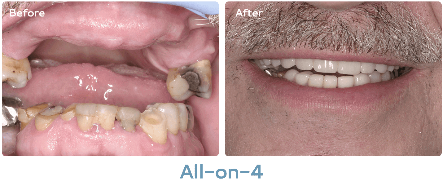 all-on-4 before & after