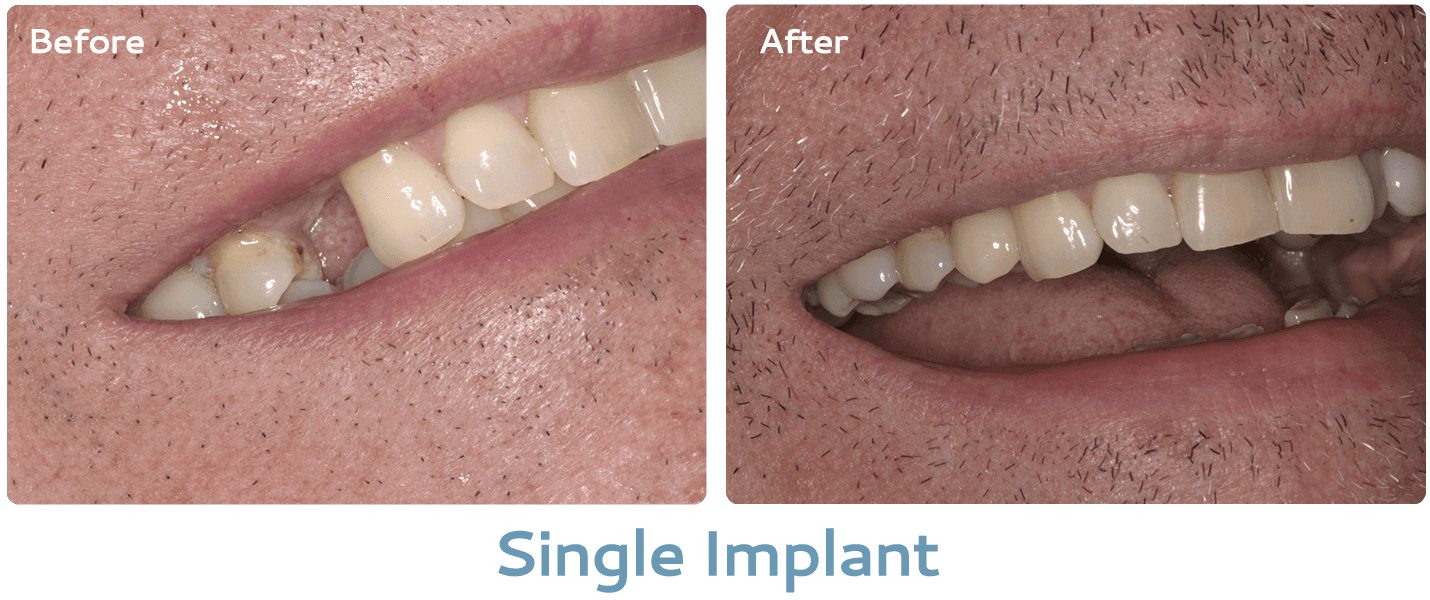 single implant before & after