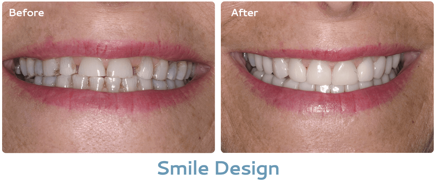 smile design before and after