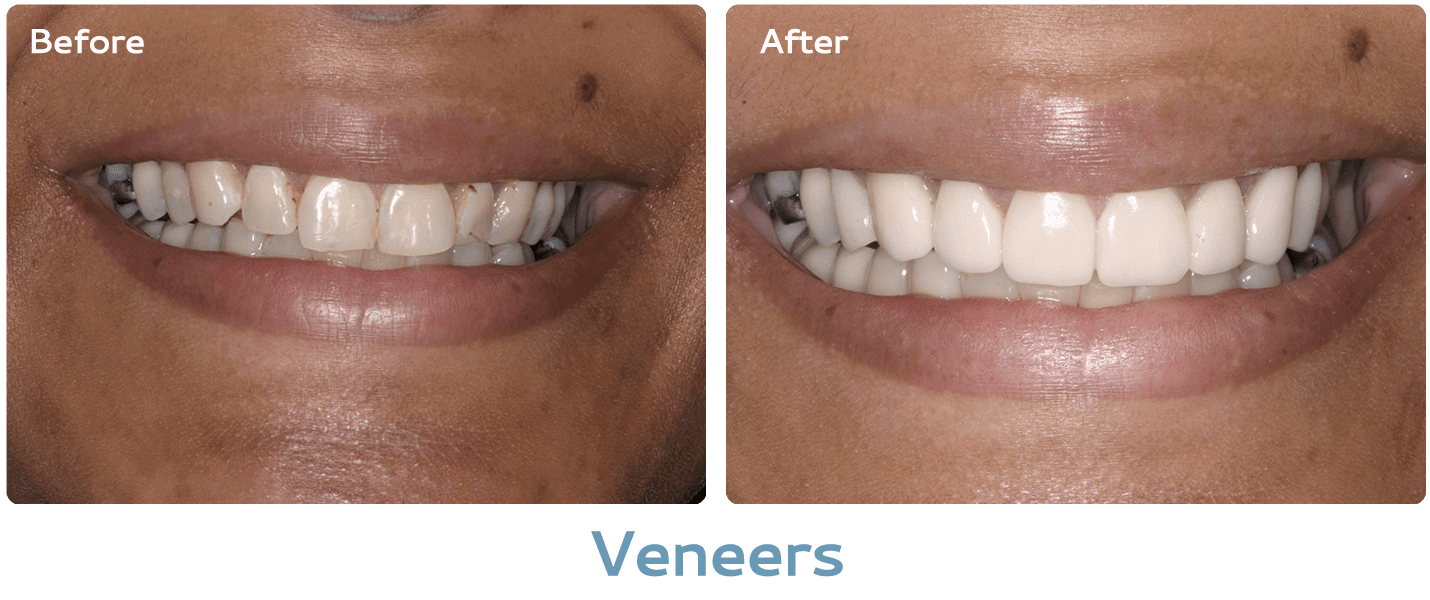 Veneers before & after